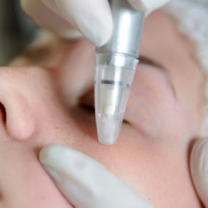 Microdermabrasion