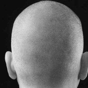 Scalp Micropigmentation – Refresher