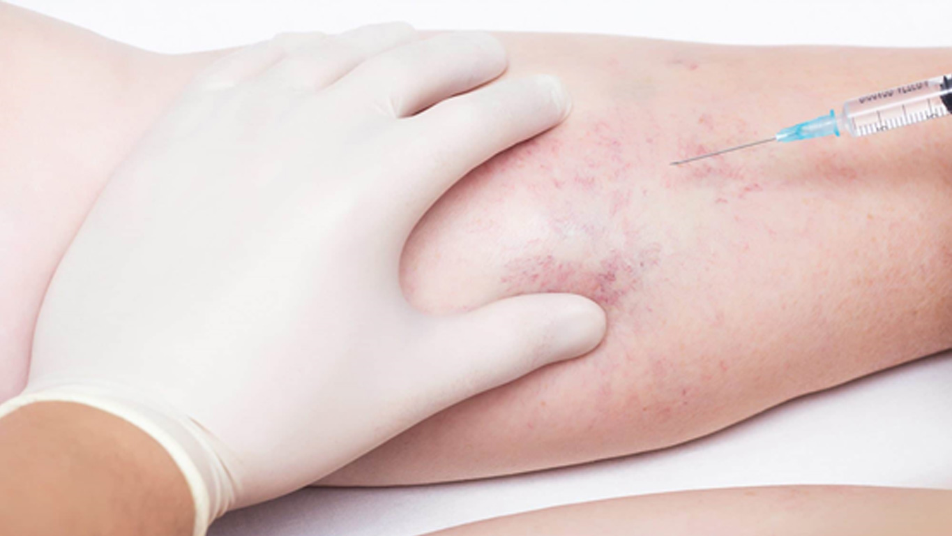 Read more about the article Micro-sclerotherapy