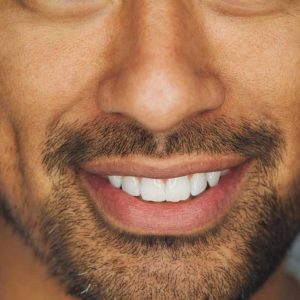 Dermal Fillers – Marionette lines & Nasolabial Folds Refresher