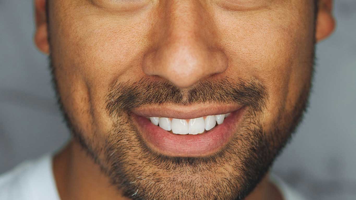 Dermal Fillers – Marionette lines & Nasolabial Folds Refresher Course