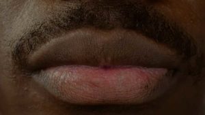 Advanced-Dermal Fillers Elevating the Oral Commissures Refresher Course