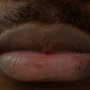 Advanced-Dermal Fillers Elevating the Oral Commissures Refresher Course