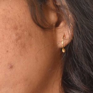 VTCT (ITEC) Level 5 in Advanced Blemish Removal