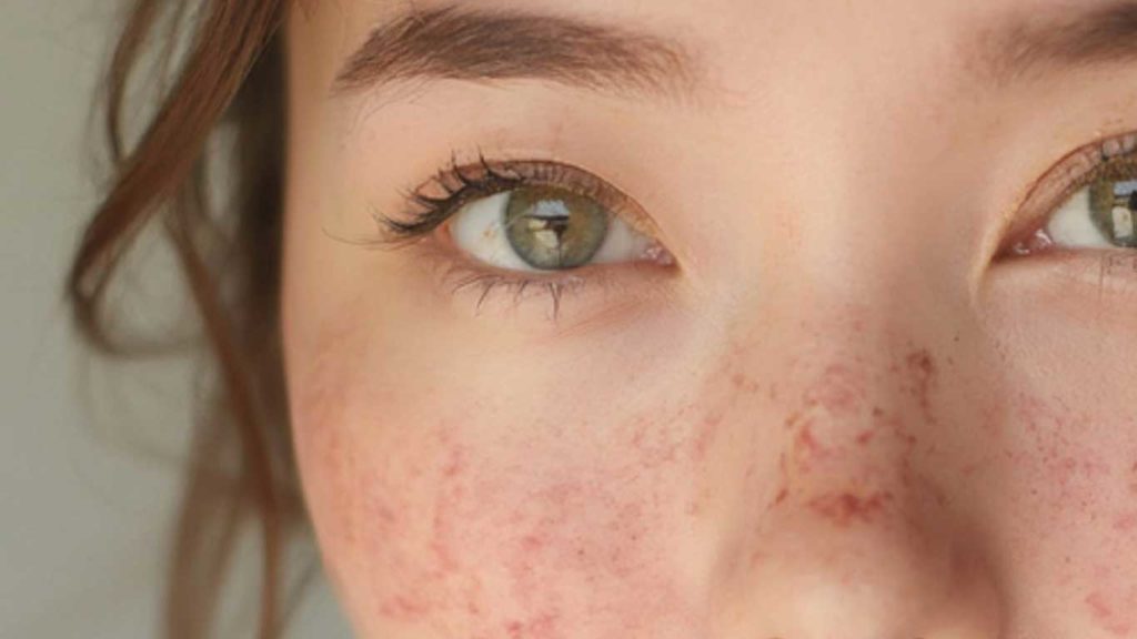 Skin Inflammation Course By ThreeSixty