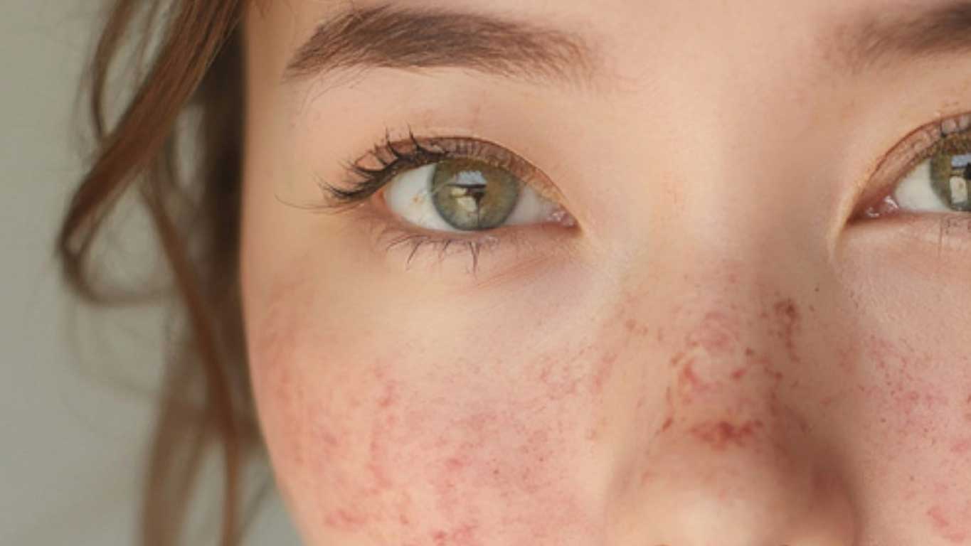 Read more about the article Skin Inflammation