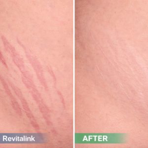 RevitalINK Inkless Scar Revision Course