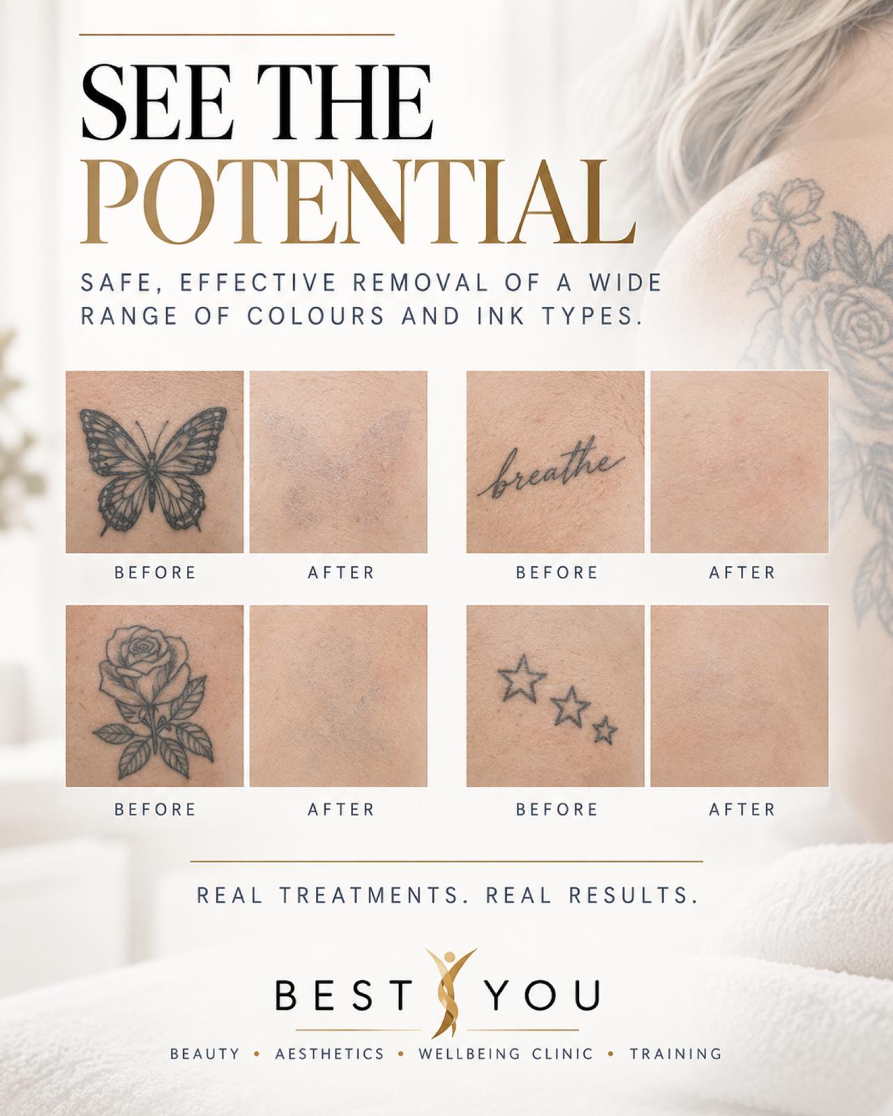 Laser tattoo removal before and after results